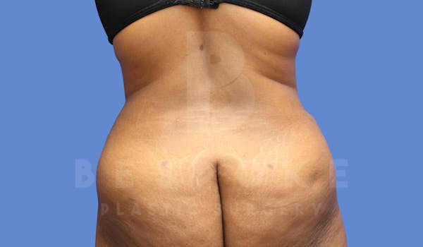 Brazilian Butt Lift Before & After Gallery - Patient 144169816 - Image 2