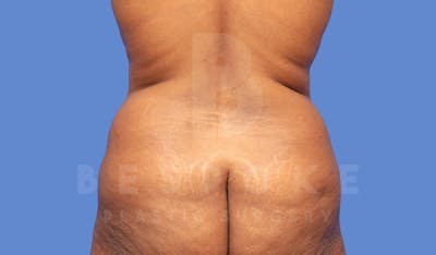 Brazilian Butt Lift Before & After Gallery - Patient 144169816 - Image 1