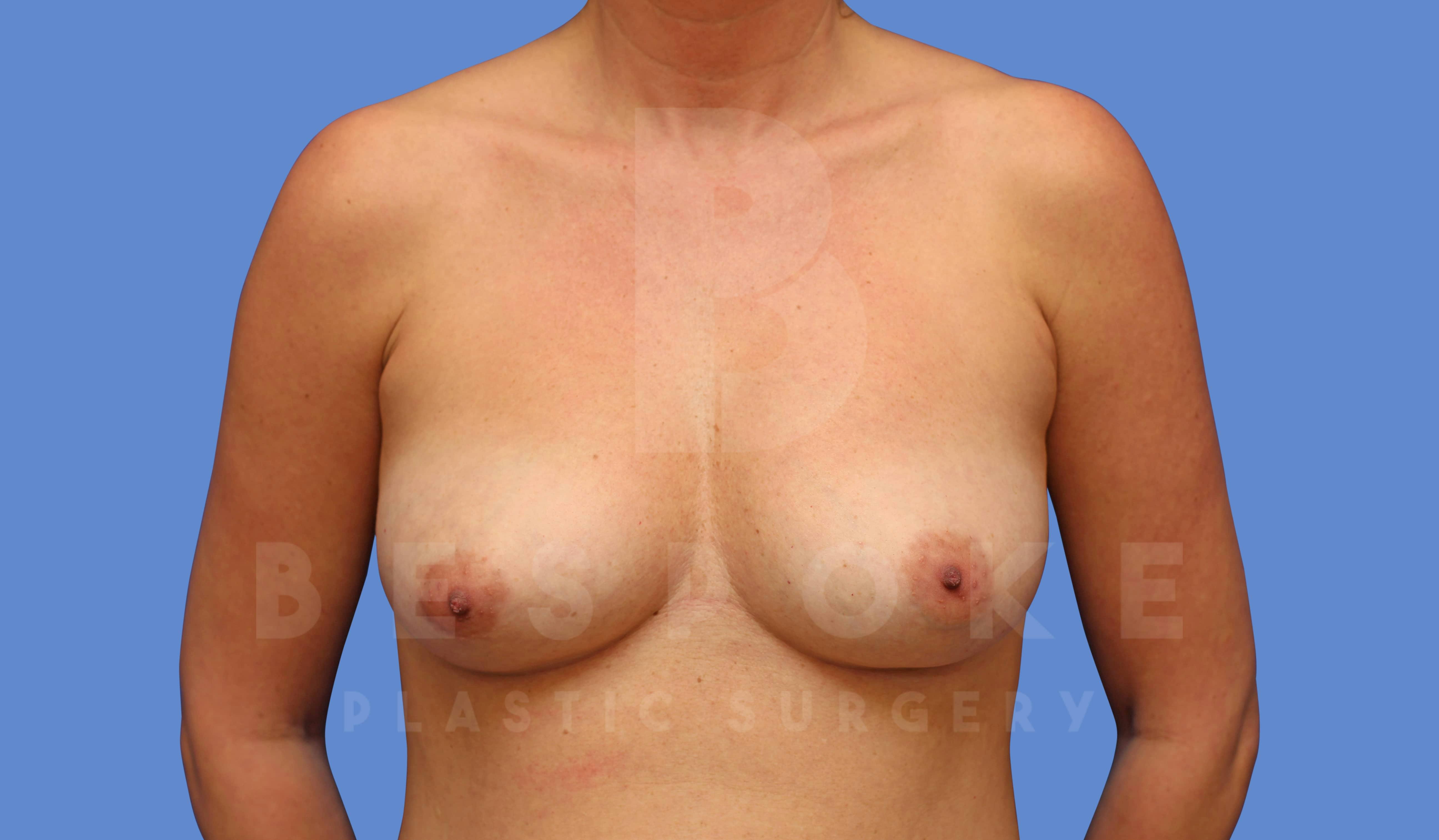 Breast Augmentation Before & After Gallery - Patient 144170030 - Image 1