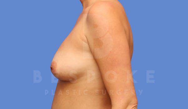 Breast Augmentation Before & After Gallery - Patient 144170030 - Image 5