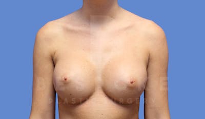 Breast Augmentation Before & After Gallery - Patient 144170029 - Image 2