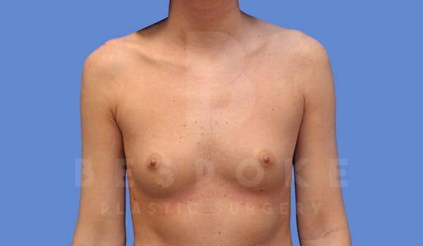 Breast Augmentation Before & After Gallery - Patient 144170029 - Image 1