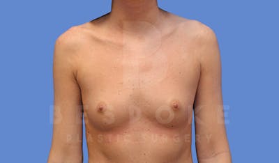 Breast Augmentation Before & After Gallery - Patient 144170029 - Image 1