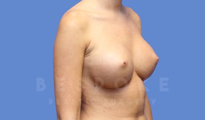 Breast Augmentation Before & After Gallery - Patient 144170029 - Image 4