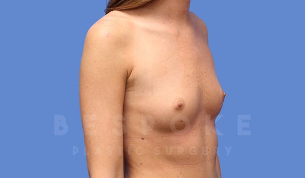 Breast Augmentation Before & After Gallery - Patient 144170029 - Image 3