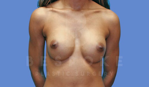 Breast Augmentation Before & After Gallery - Patient 144170028 - Image 2