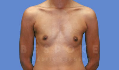 Breast Augmentation Before & After Gallery - Patient 144170028 - Image 1