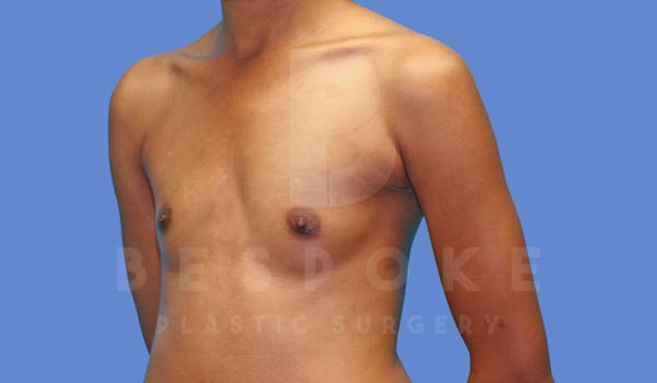 Breast Augmentation Before & After Gallery - Patient 144170028 - Image 3