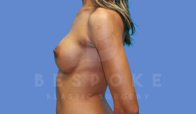 Breast Augmentation Before & After Gallery - Patient 144170028 - Image 6