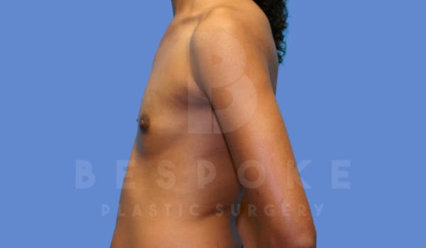 Breast Augmentation Before & After Gallery - Patient 144170028 - Image 5