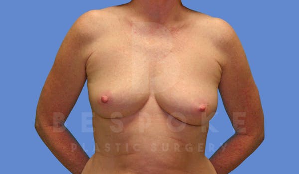 Breast Augmentation Before & After Gallery - Patient 144170027 - Image 1