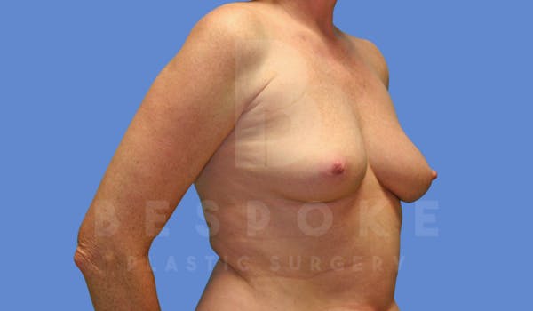Breast Augmentation Before & After Gallery - Patient 144170027 - Image 3
