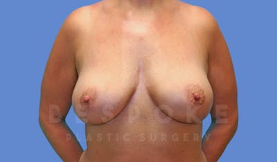 Breast Lift With Implants Before & After Gallery - Patient 144170277 - Image 2