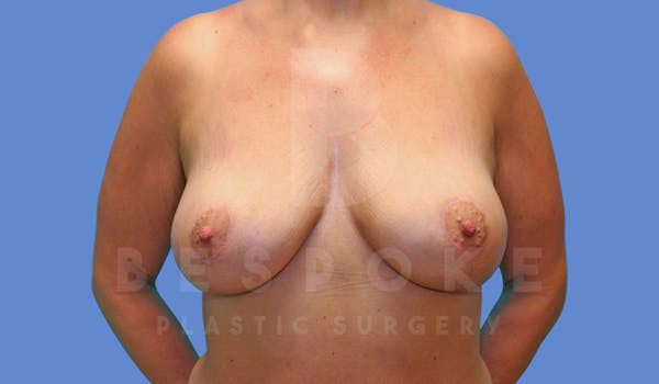 Breast Lift With Implants Before & After Gallery - Patient 144170277 - Image 2