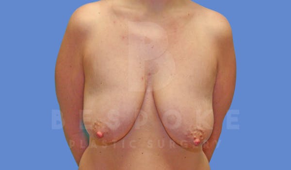 Breast Lift With Implants Before & After Gallery - Patient 144170277 - Image 1