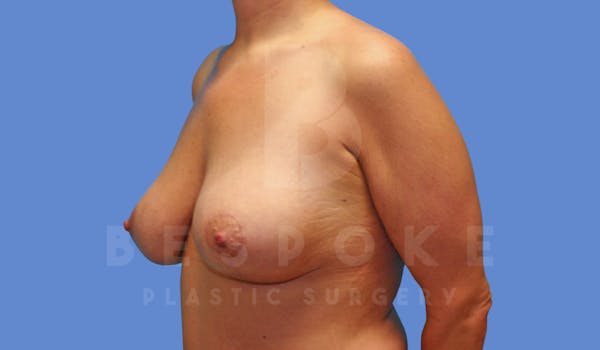 Breast Lift With Implants Before & After Gallery - Patient 144170277 - Image 4