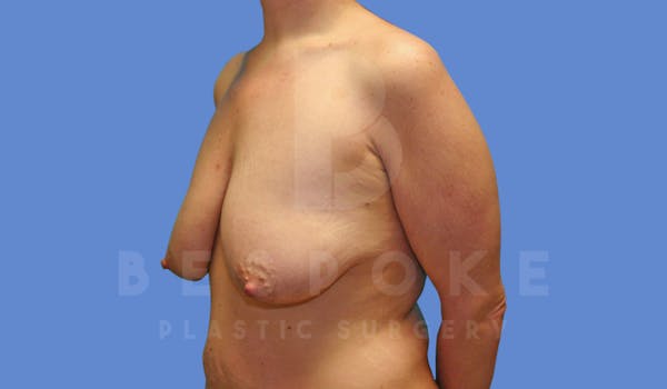 Breast Lift With Implants Before & After Gallery - Patient 144170277 - Image 3