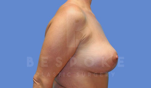 Breast Lift With Implants Before & After Gallery - Patient 144170277 - Image 6