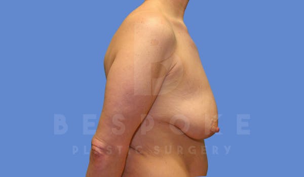 Breast Lift With Implants Before & After Gallery - Patient 144170277 - Image 5