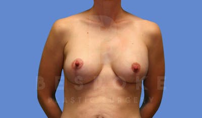 Breast Lift With Implants Before & After Gallery - Patient 144170276 - Image 2