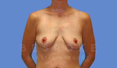 Breast Lift With Implants Before & After Gallery - Patient 144170276 - Image 1
