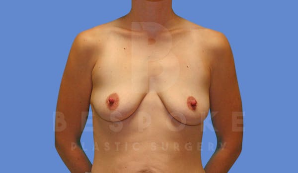Breast Lift With Implants Before & After Gallery - Patient 144170276 - Image 1