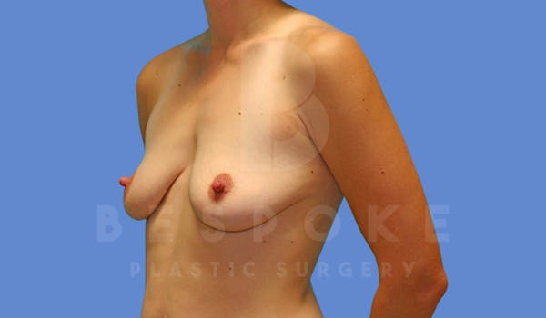Breast Lift With Implants Before & After Gallery - Patient 144170276 - Image 3