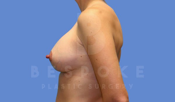 Breast Lift With Implants Before & After Gallery - Patient 144170276 - Image 6