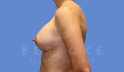 Breast Lift With Implants Before & After Gallery - Patient 144170276 - Image 6