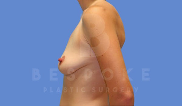 Breast Lift With Implants Before & After Gallery - Patient 144170276 - Image 5