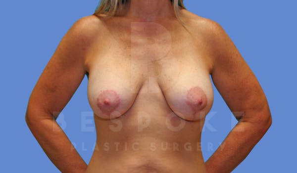 Breast Lift With Implants Before & After Gallery - Patient 144170275 - Image 2