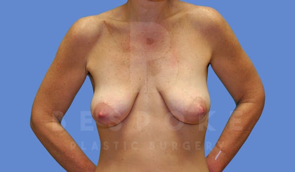Breast Lift With Implants Before & After Gallery - Patient 144170275 - Image 1