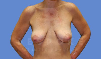 Breast Lift With Implants Before & After Gallery - Patient 144170275 - Image 1