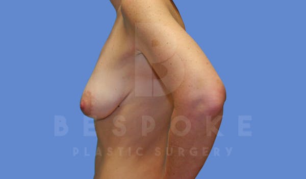 Breast Lift With Implants Before & After Gallery - Patient 144170275 - Image 5