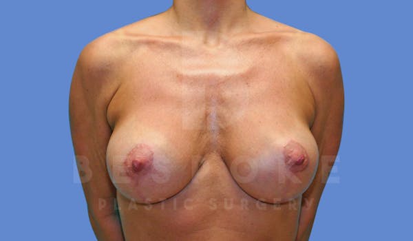Breast Lift With Implants Before & After Gallery - Patient 144170274 - Image 2