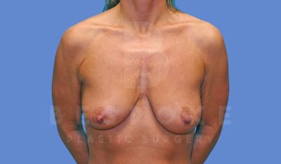 Breast Lift With Implants Before & After Gallery - Patient 144170274 - Image 1