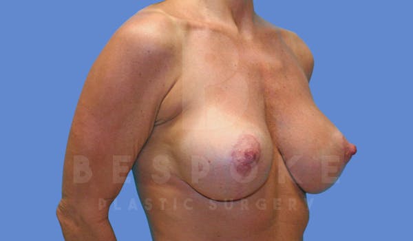 Breast Lift With Implants Before & After Gallery - Patient 144170274 - Image 4