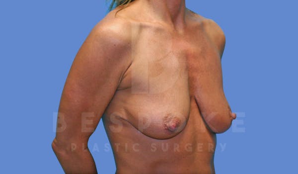 Breast Lift With Implants Before & After Gallery - Patient 144170274 - Image 3
