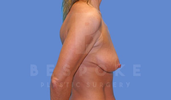 Breast Lift With Implants Before & After Gallery - Patient 144170274 - Image 5