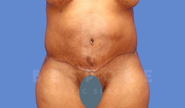 Corrective Body Surgery Before & After Gallery - Patient 144170592 - Image 2