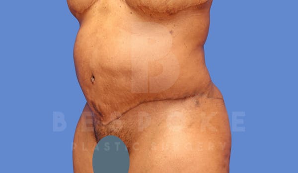 Corrective Body Surgery Before & After Gallery - Patient 144170592 - Image 4