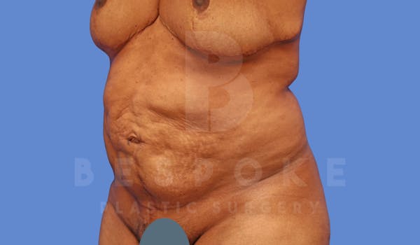 Corrective Body Surgery Before & After Gallery - Patient 144170592 - Image 3