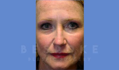 Facial Fat Grafting Before & After Gallery - Patient 144170605 - Image 2