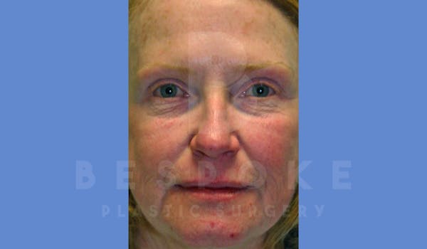 Facial Fat Grafting Before & After Gallery - Patient 144170605 - Image 1