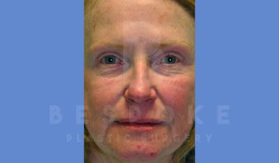 Facial Fat Grafting Before & After Gallery - Patient 144170605 - Image 1