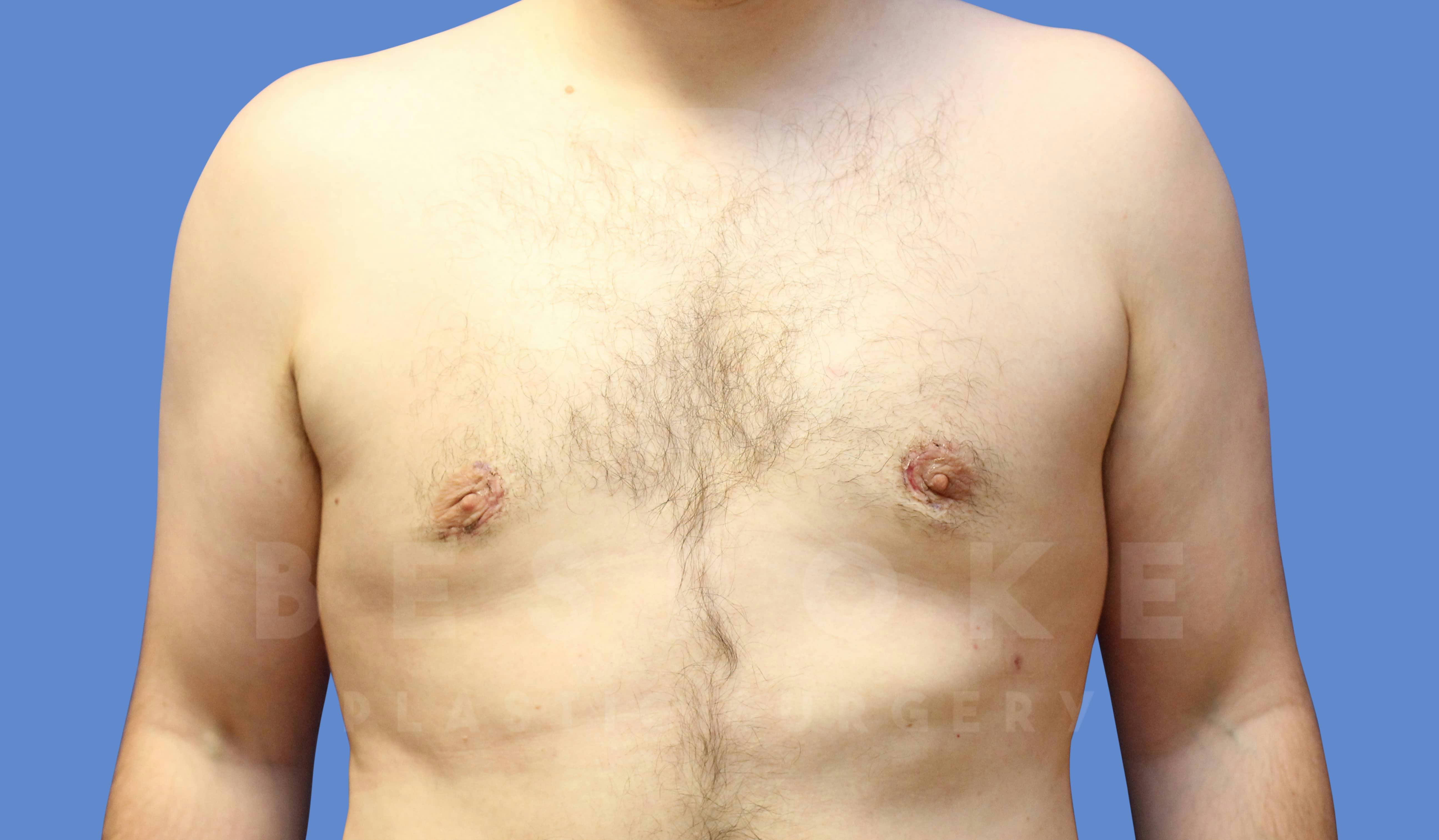 Gynecomastia Before & After Gallery - Patient 144170618 - Image 2