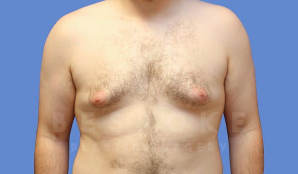 Gynecomastia Before & After Gallery - Patient 144170618 - Image 1