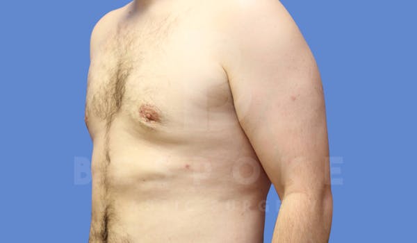 Gynecomastia Before & After Gallery - Patient 144170618 - Image 4
