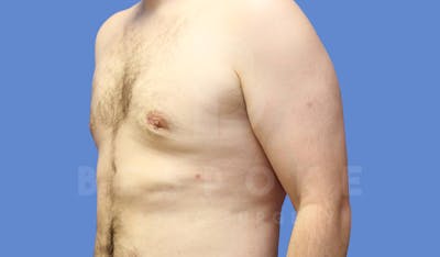 Gynecomastia Before & After Gallery - Patient 144170618 - Image 4
