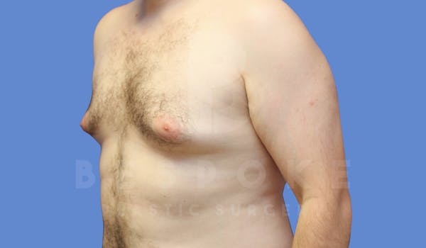 Gynecomastia Before & After Gallery - Patient 144170618 - Image 3